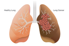 LungCancer-360x240.png